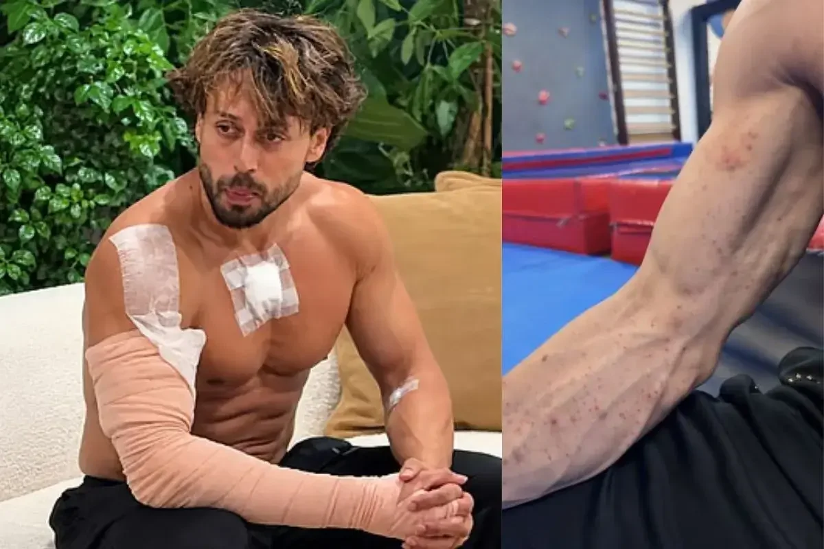 Tiger Shroff gunpowder burn marks: पट्टियों में अभिनेता और उनकी बांह पर बर्न के निशानों का क्लोज अप